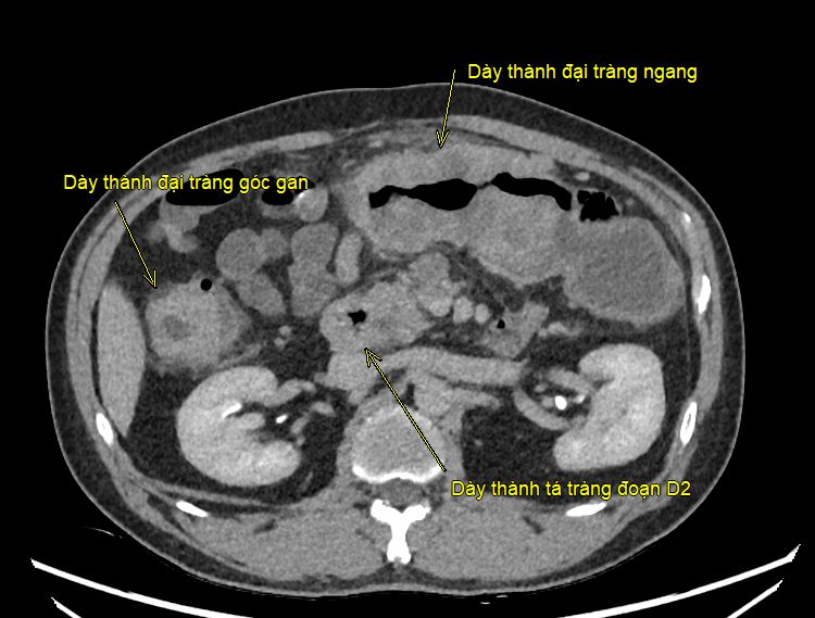 Ca đại phẫu kéo dài hơn 8 giờ giải cứu bệnh nhân mắc ung thư kép - Ảnh 2