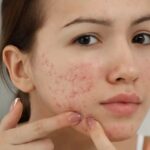 5 cách chăm sóc da sau mụn giúp vùng thâm sạm dần cải thiện